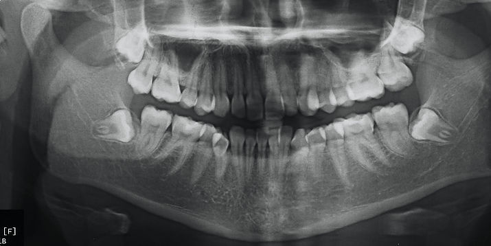 wisdom teeth removal aspendale