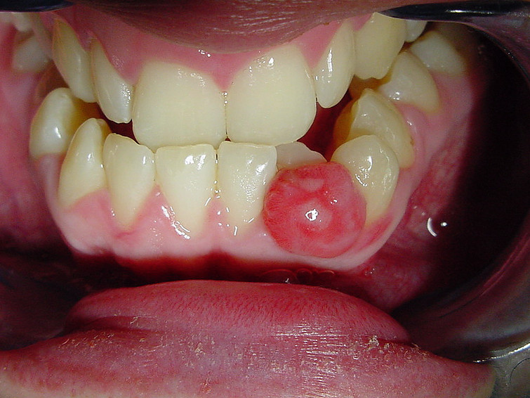 Wisdom Tooth Cyst On Gum